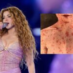 After Shakira Concert: Thousands at Risk of Measles Infection! (Photo: Shakira performs at MetLife Stadium on Friday, May 16, 2025, in East Rutherford, N.J. (Photo by Charles Sykes/Invision/AP)