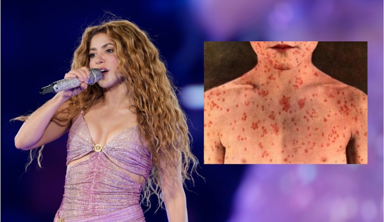 After Shakira Concert: Thousands at Risk of Measles Infection! (Photo: Shakira performs at MetLife Stadium on Friday, May 16, 2025, in East Rutherford, N.J. (Photo by Charles Sykes/Invision/AP)