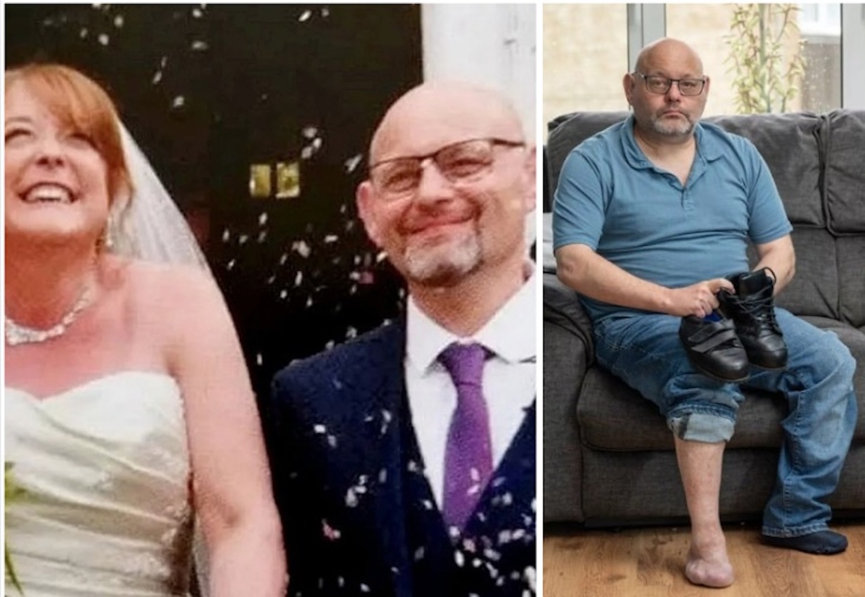 Groom Needs Toes Amputation After Wearing Tight Wedding Shoes (Photo: Mirror UK)